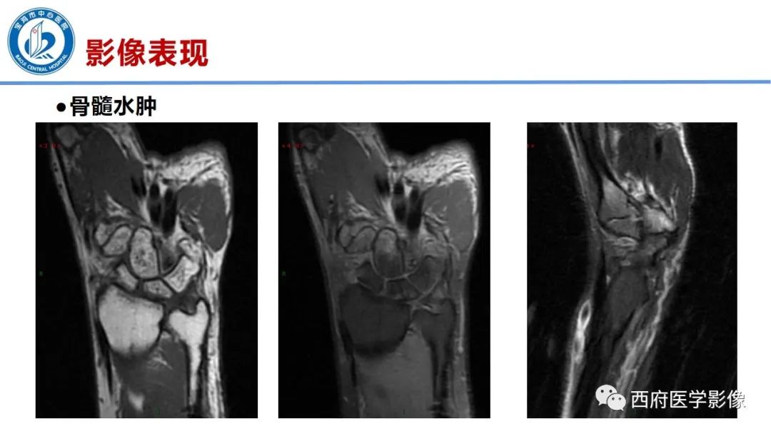 影像PPT - 【PPT】类风湿性关节炎的早期影像学诊断-18