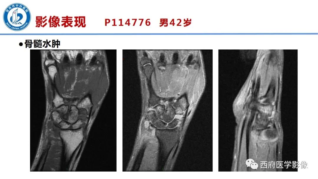 影像PPT - 【PPT】类风湿性关节炎的早期影像学诊断-19