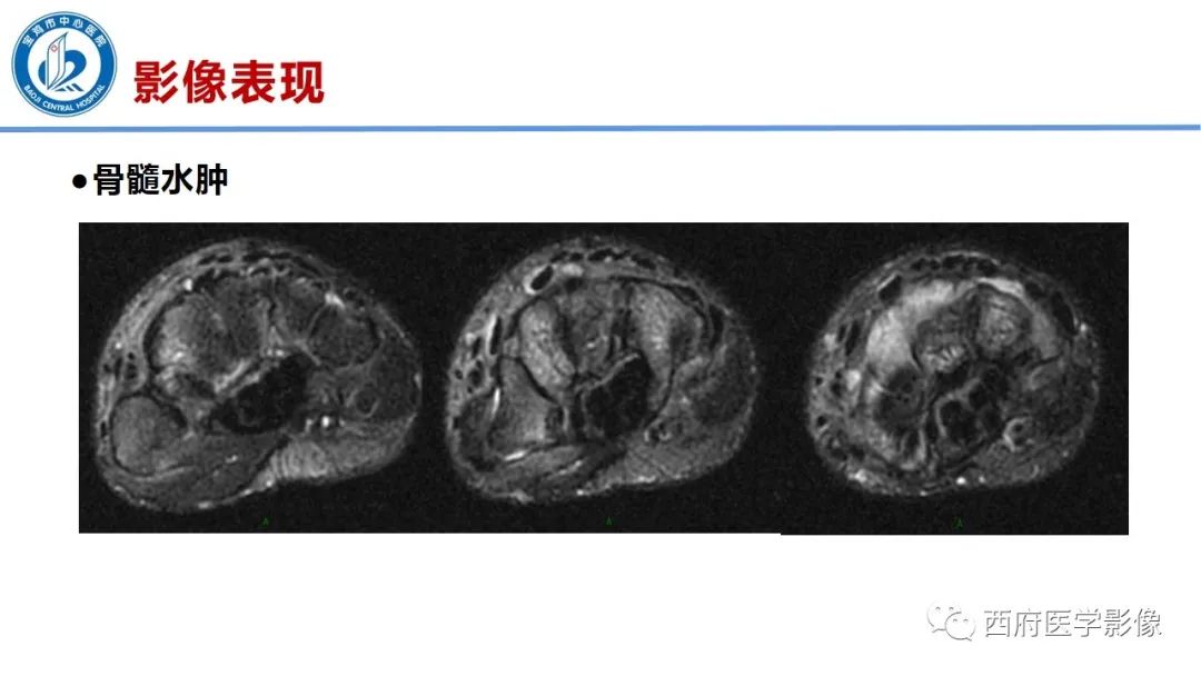 影像PPT - 【PPT】类风湿性关节炎的早期影像学诊断-20