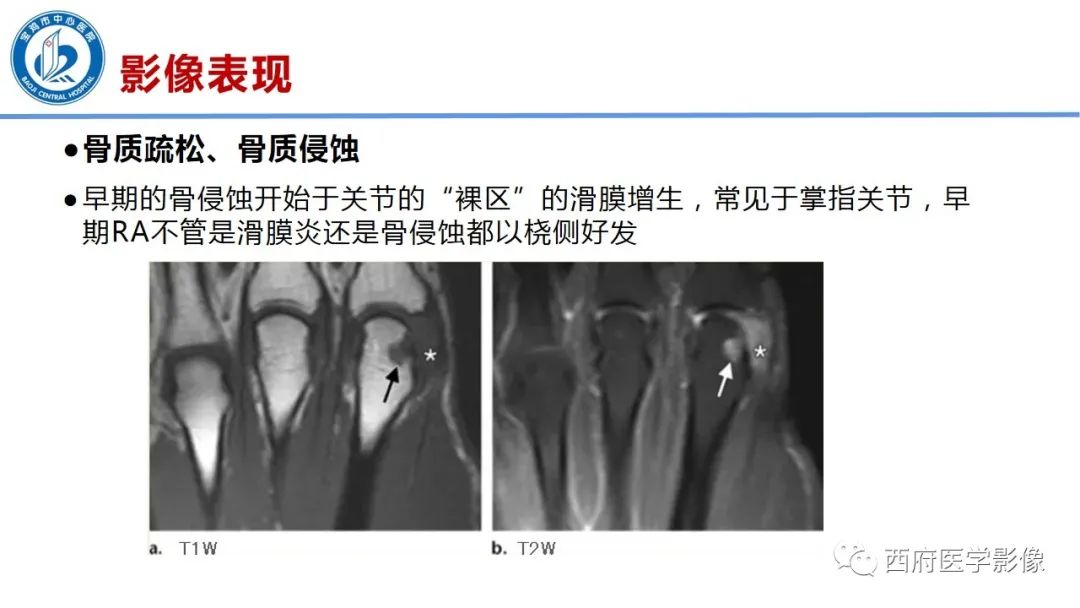 影像PPT - 【PPT】类风湿性关节炎的早期影像学诊断-21