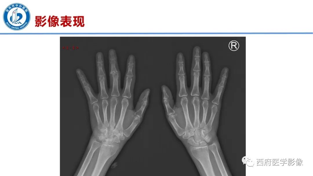 影像PPT - 【PPT】类风湿性关节炎的早期影像学诊断-22