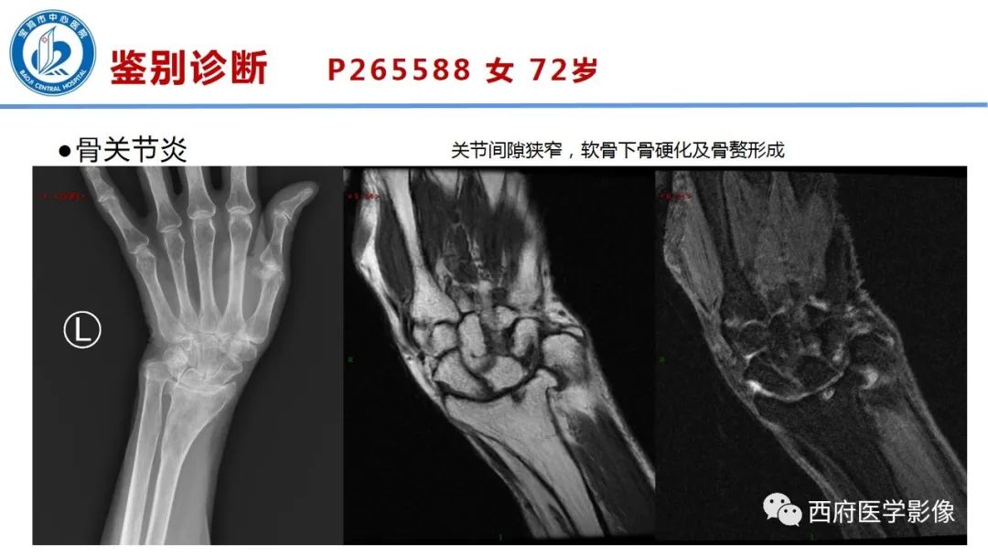 影像PPT - 【PPT】类风湿性关节炎的早期影像学诊断-26