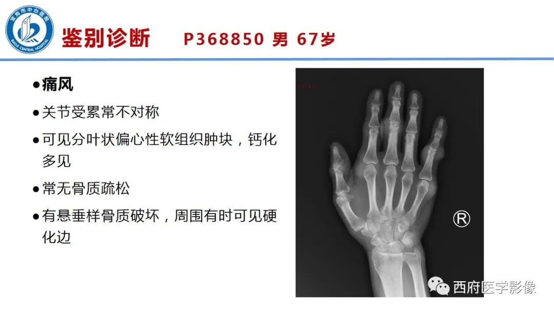 影像PPT - 【PPT】类风湿性关节炎的早期影像学诊断-27