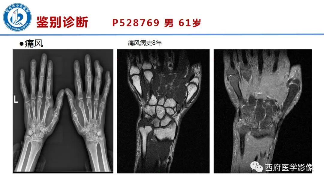 影像PPT - 【PPT】类风湿性关节炎的早期影像学诊断-28