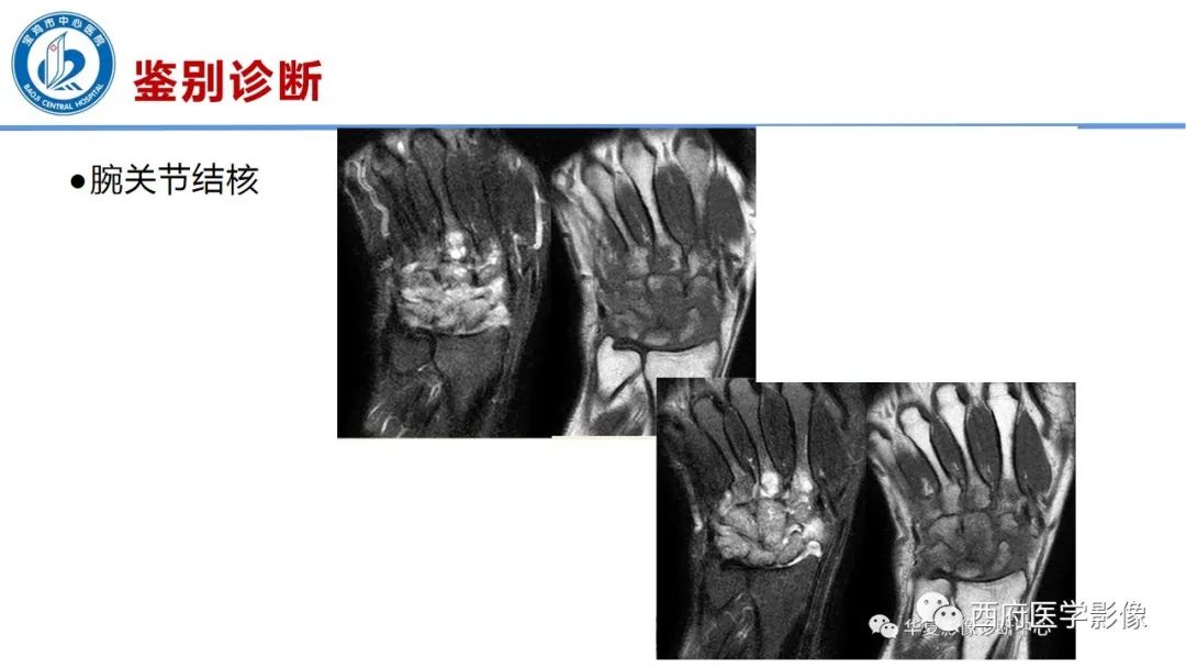 影像PPT - 【PPT】类风湿性关节炎的早期影像学诊断-29
