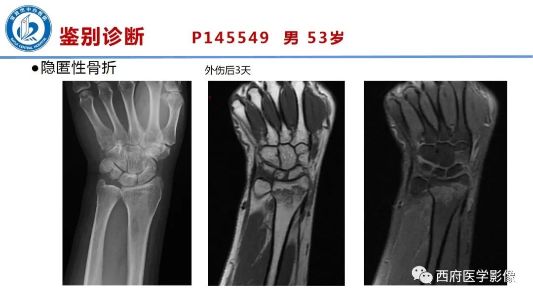 影像PPT - 【PPT】类风湿性关节炎的早期影像学诊断-30