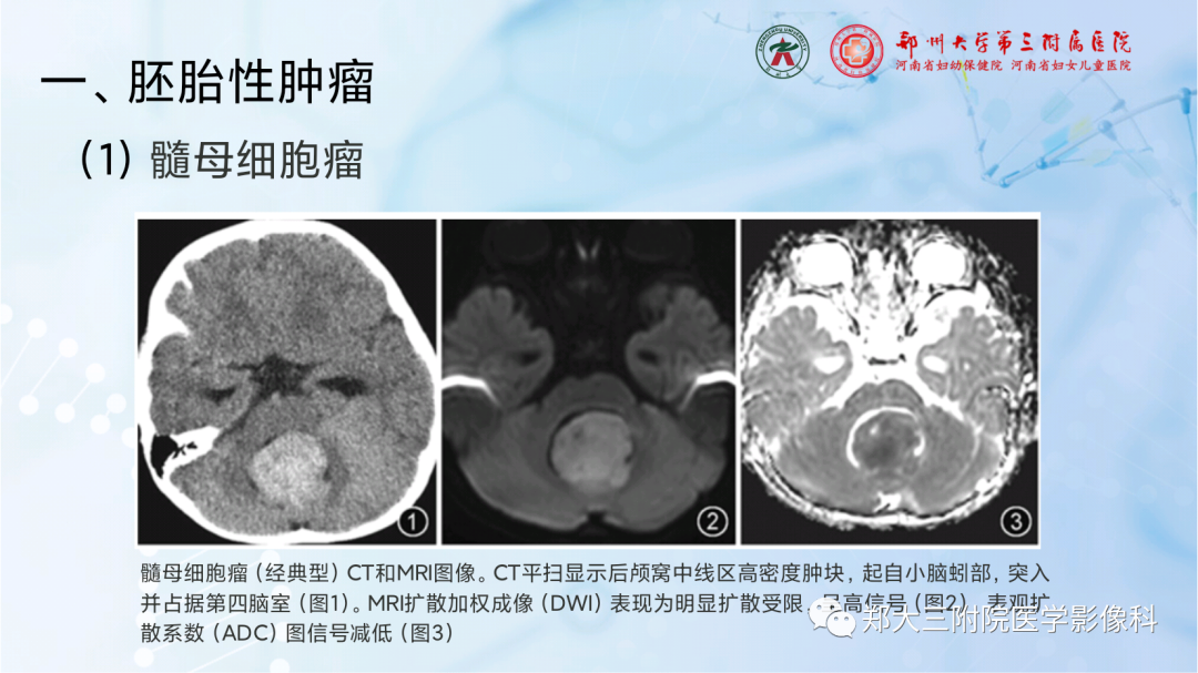 影像PPT - 【PPT】儿童后颅窝肿瘤的影像学诊断思路-14