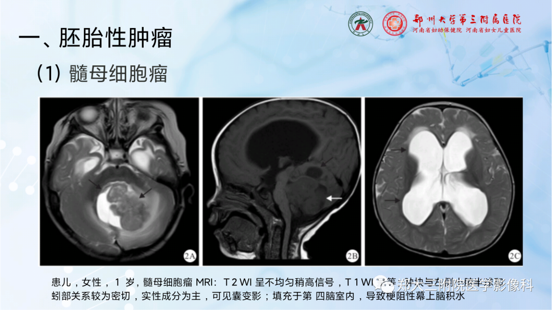 影像PPT - 【PPT】儿童后颅窝肿瘤的影像学诊断思路-15