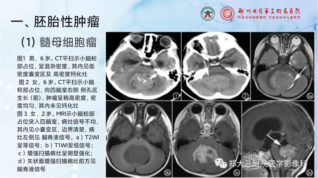影像PPT - 【PPT】儿童后颅窝肿瘤的影像学诊断思路-16