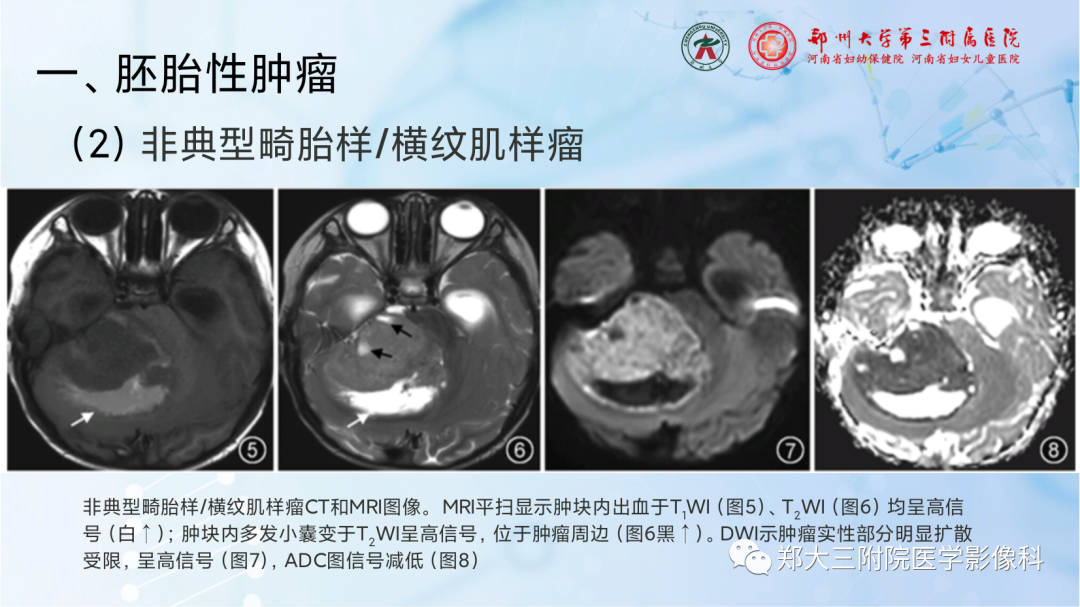 影像PPT - 【PPT】儿童后颅窝肿瘤的影像学诊断思路-20