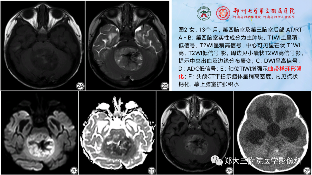 影像PPT - 【PPT】儿童后颅窝肿瘤的影像学诊断思路-21