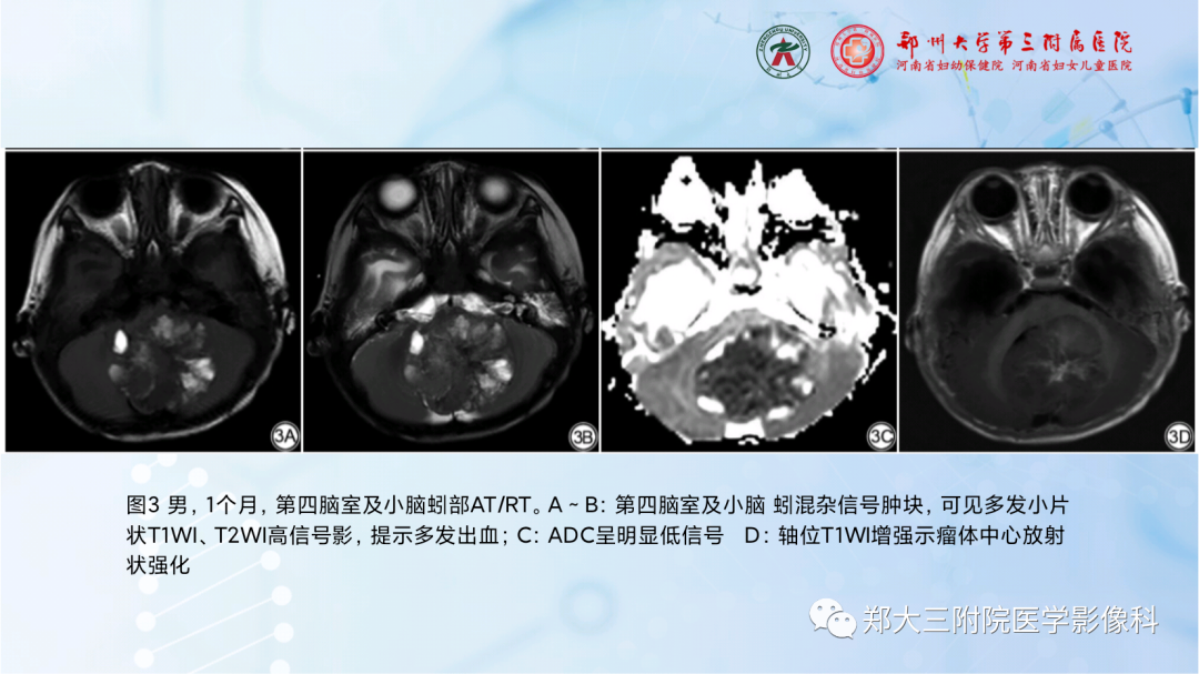 影像PPT - 【PPT】儿童后颅窝肿瘤的影像学诊断思路-22