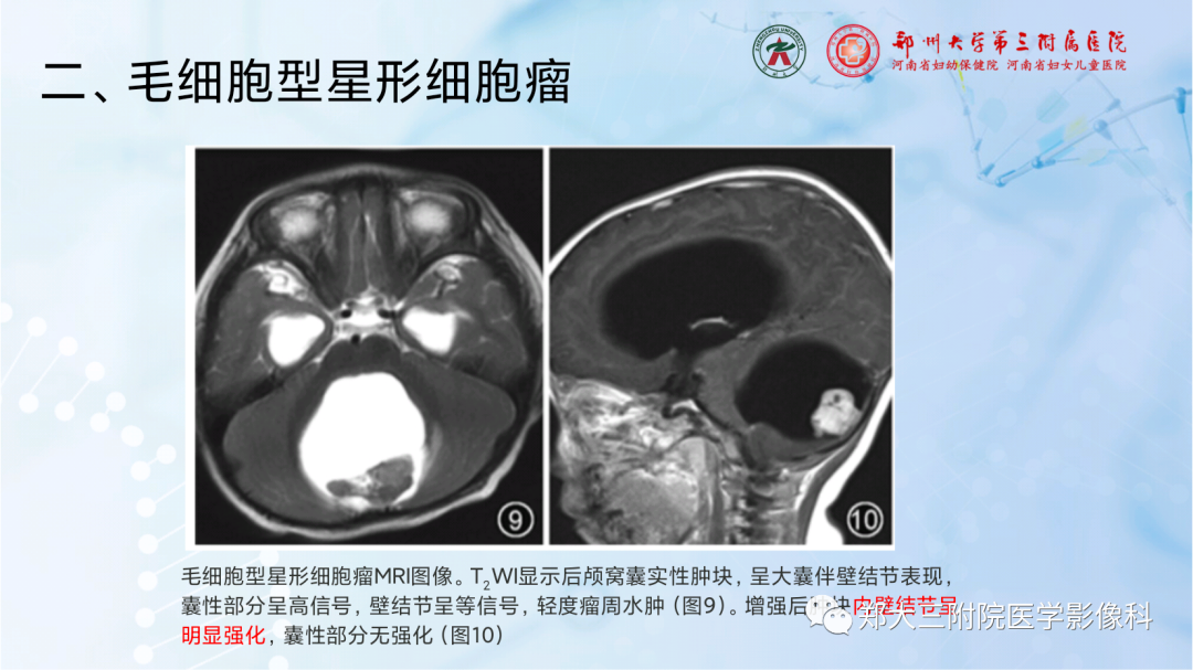 影像PPT - 【PPT】儿童后颅窝肿瘤的影像学诊断思路-26