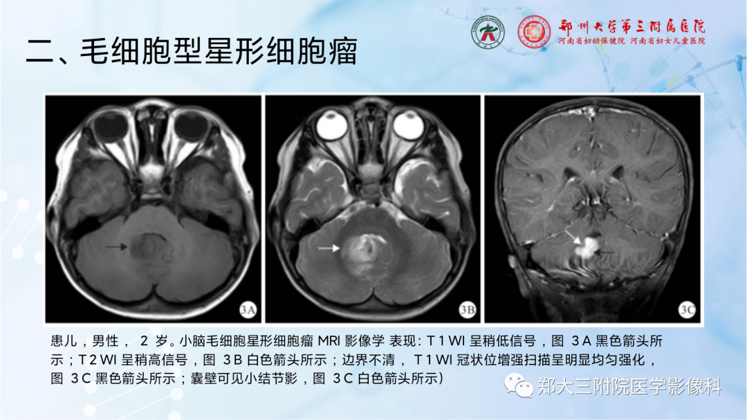 影像PPT - 【PPT】儿童后颅窝肿瘤的影像学诊断思路-27