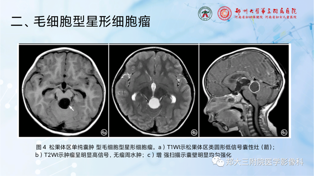 影像PPT - 【PPT】儿童后颅窝肿瘤的影像学诊断思路-29
