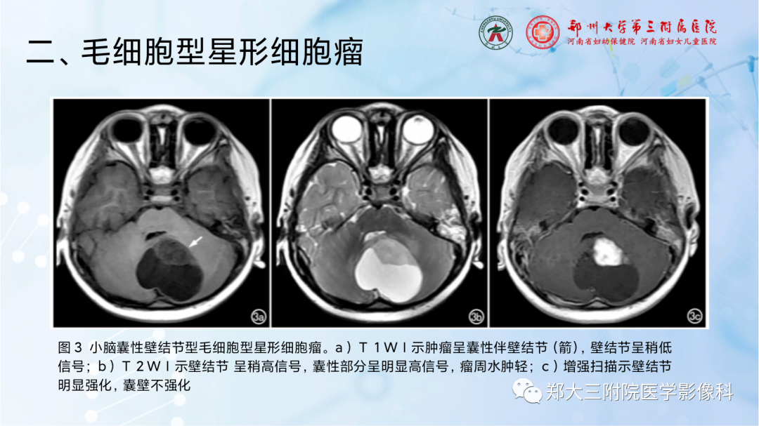 影像PPT - 【PPT】儿童后颅窝肿瘤的影像学诊断思路-28