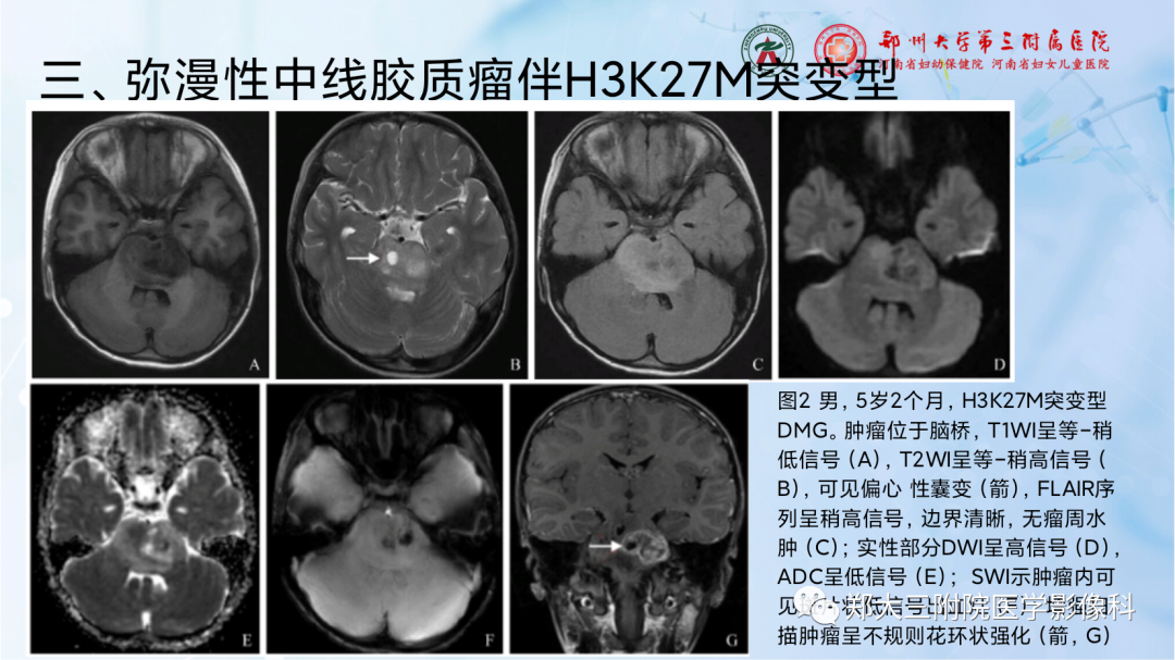 影像PPT - 【PPT】儿童后颅窝肿瘤的影像学诊断思路-33