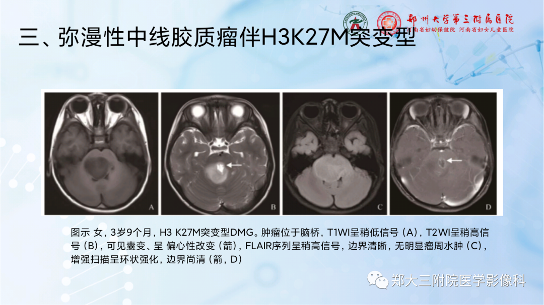 影像PPT - 【PPT】儿童后颅窝肿瘤的影像学诊断思路-34