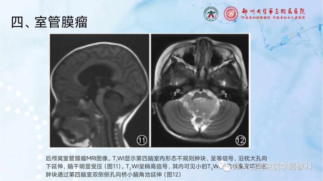 影像PPT - 【PPT】儿童后颅窝肿瘤的影像学诊断思路-38