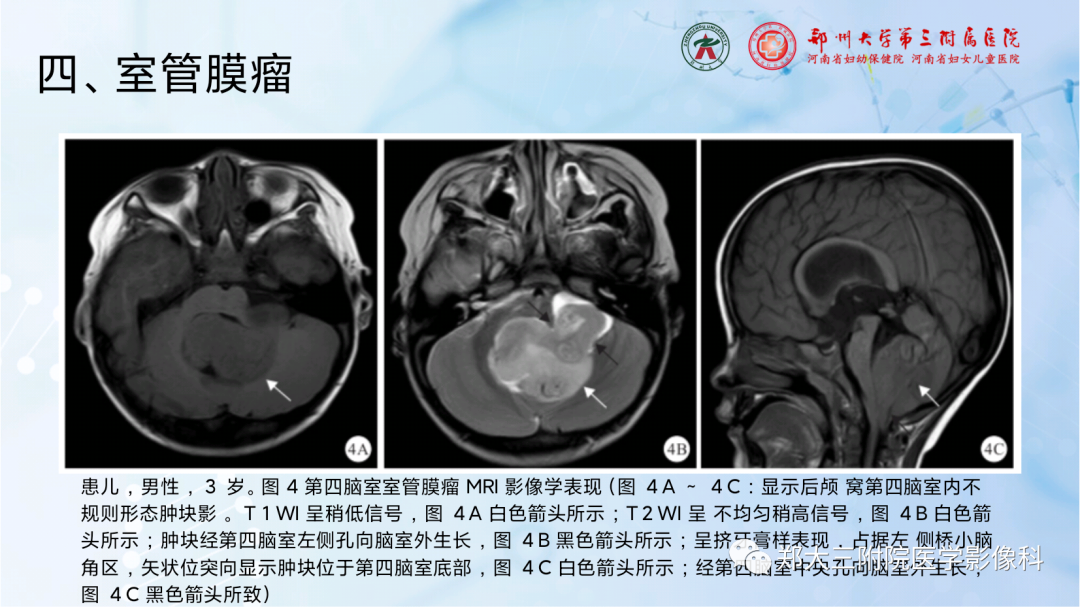影像PPT - 【PPT】儿童后颅窝肿瘤的影像学诊断思路-39