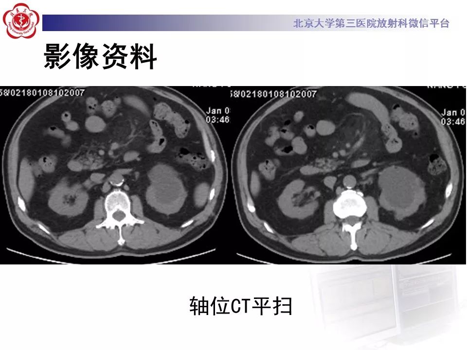 影像PPT - 【PPT】肠系膜脂膜炎-3