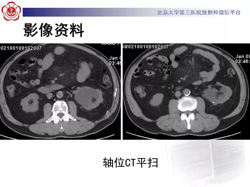 影像PPT - 【PPT】肠系膜脂膜炎-4