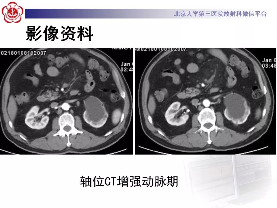 影像PPT - 【PPT】肠系膜脂膜炎-5