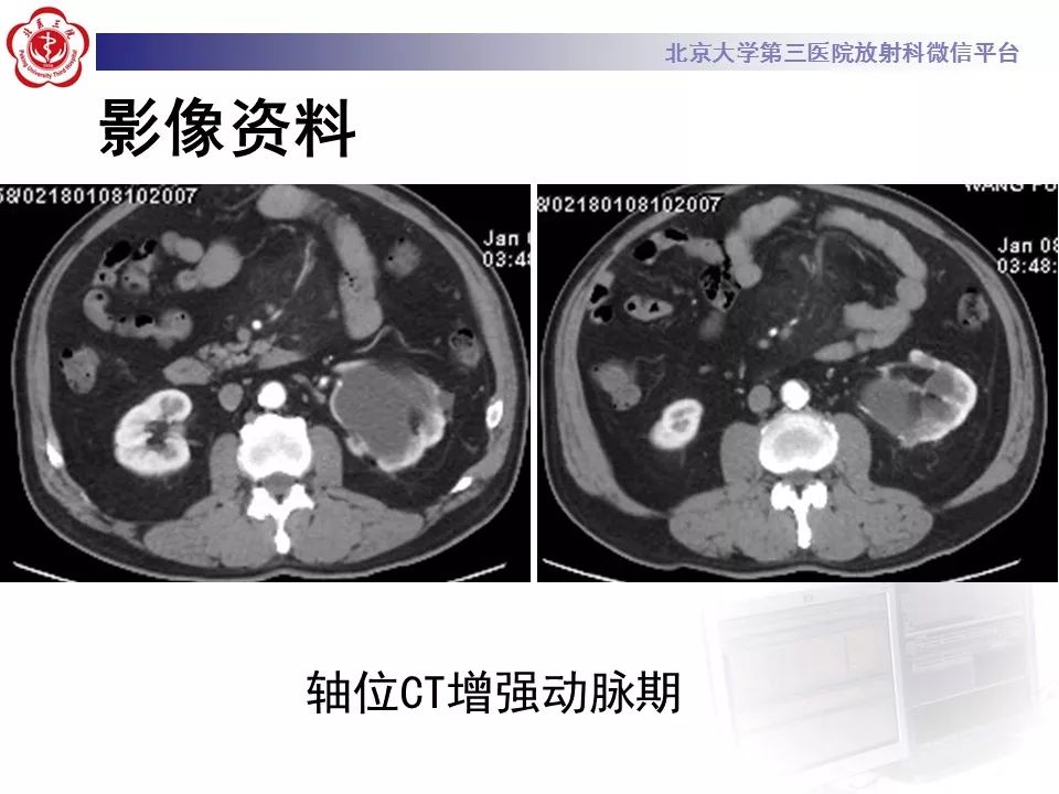 影像PPT - 【PPT】肠系膜脂膜炎-6