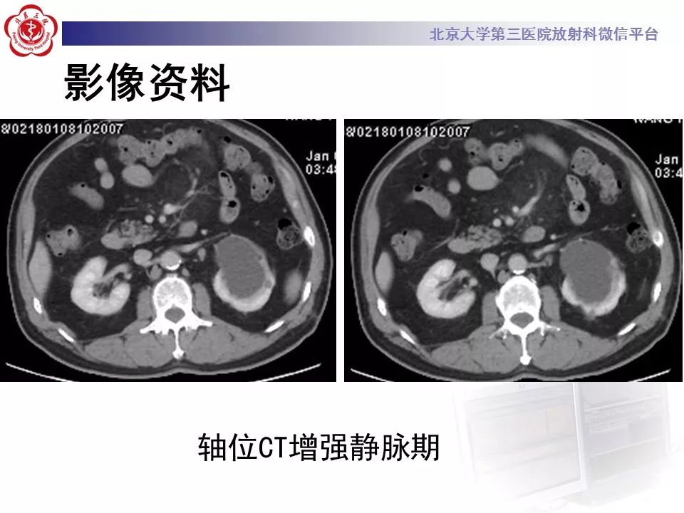 影像PPT - 【PPT】肠系膜脂膜炎-7