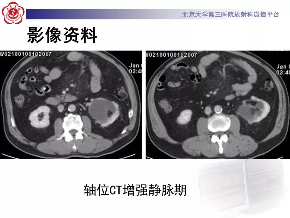影像PPT - 【PPT】肠系膜脂膜炎-8
