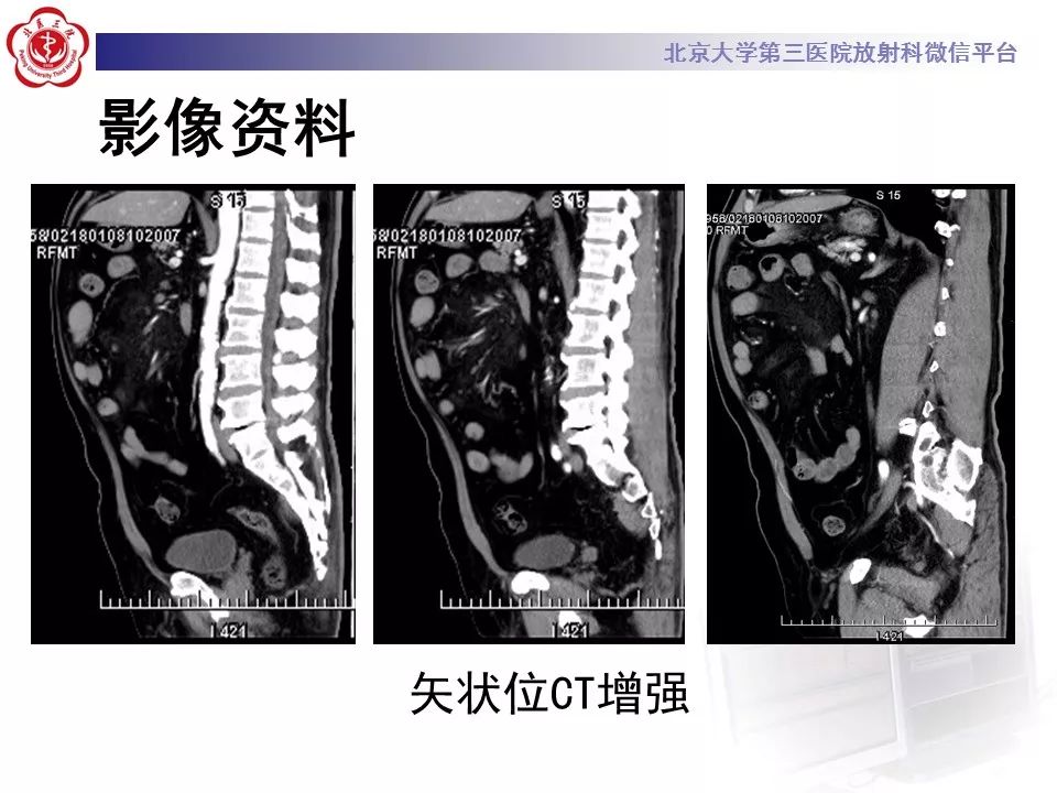 影像PPT - 【PPT】肠系膜脂膜炎-9