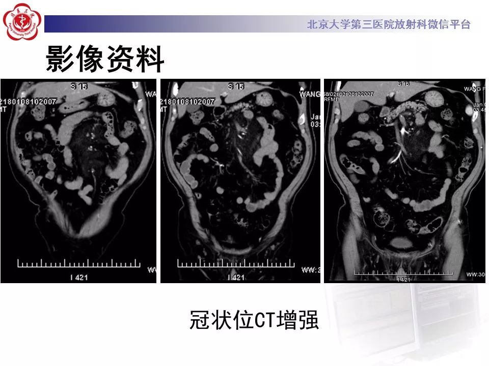 影像PPT - 【PPT】肠系膜脂膜炎-10