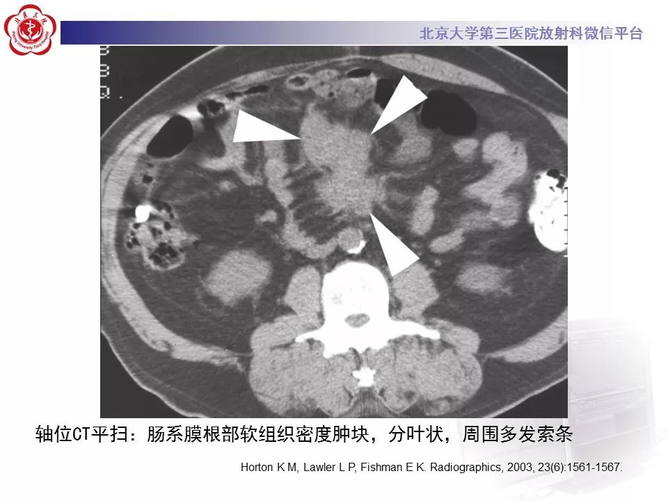 影像PPT - 【PPT】肠系膜脂膜炎-25