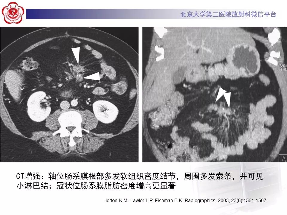影像PPT - 【PPT】肠系膜脂膜炎-26