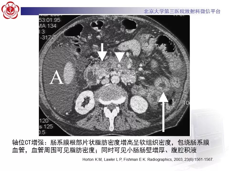 影像PPT - 【PPT】肠系膜脂膜炎-28