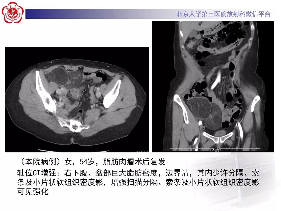 影像PPT - 【PPT】肠系膜脂膜炎-32