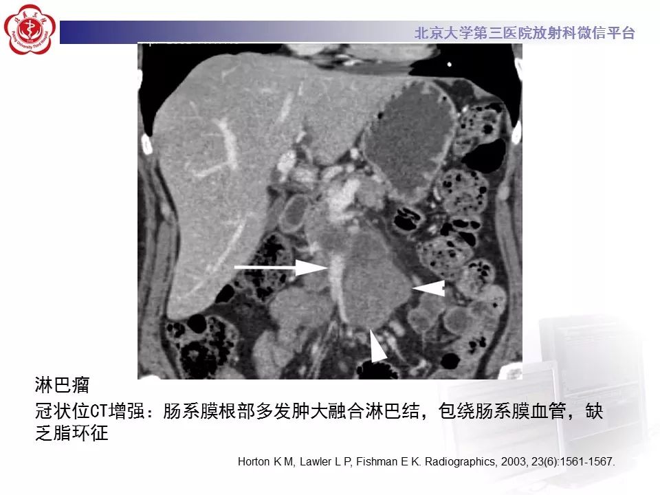影像PPT - 【PPT】肠系膜脂膜炎-34