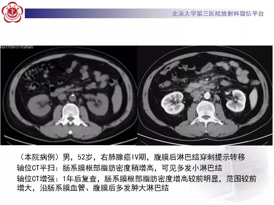 影像PPT - 【PPT】肠系膜脂膜炎-36