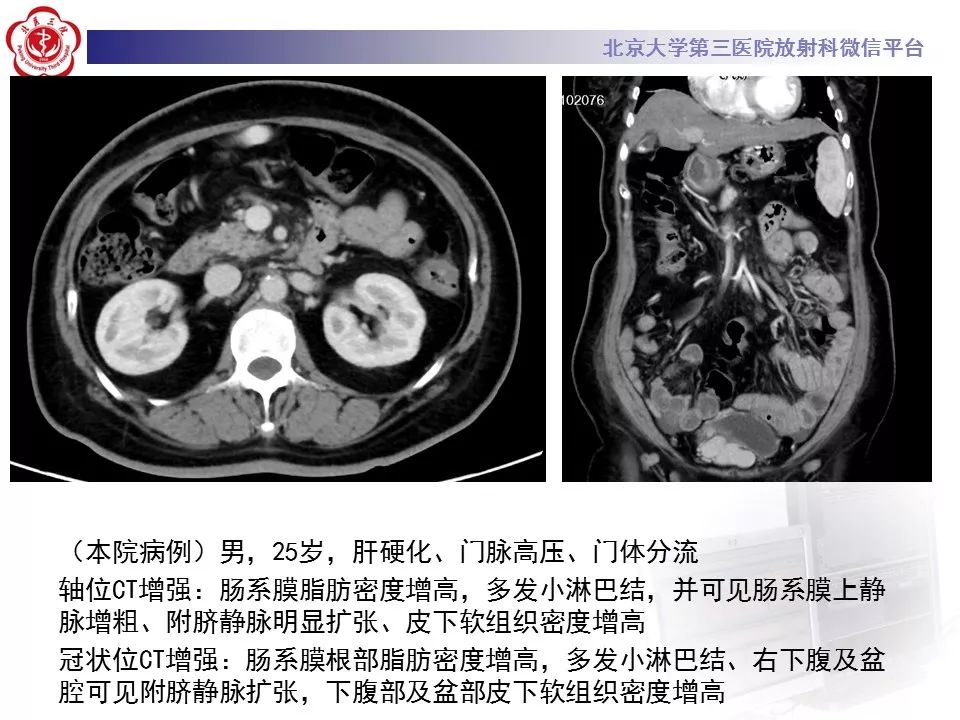 影像PPT - 【PPT】肠系膜脂膜炎-40