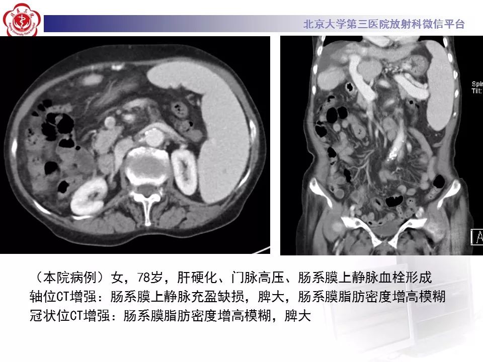 影像PPT - 【PPT】肠系膜脂膜炎-41