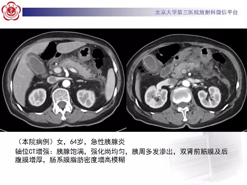 影像PPT - 【PPT】肠系膜脂膜炎-43