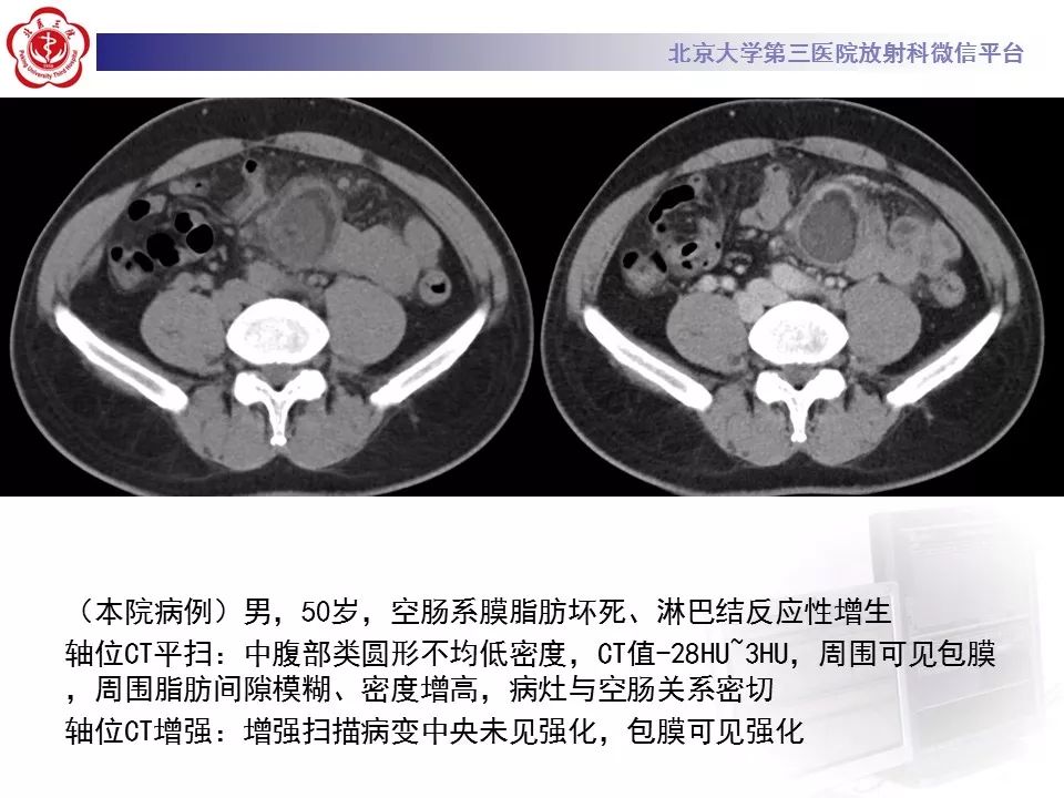 影像PPT - 【PPT】肠系膜脂膜炎-45