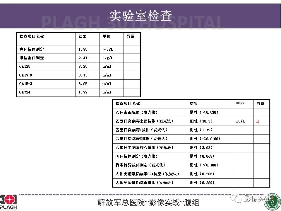 影像PPT - 【病例】肝脏神经内分泌肿瘤-3
