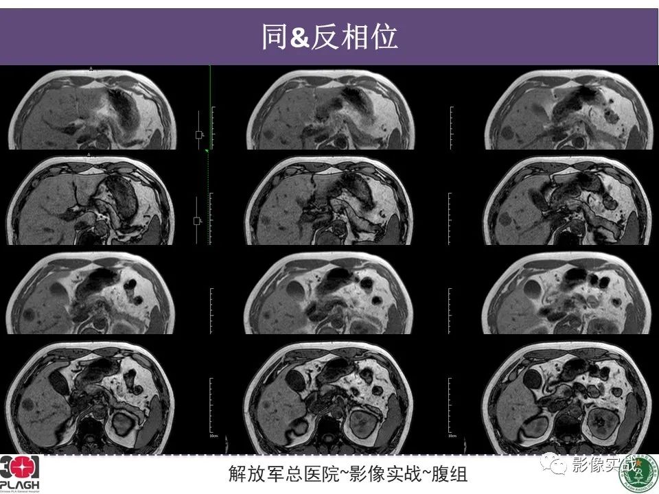 影像PPT - 【病例】肝脏神经内分泌肿瘤-7