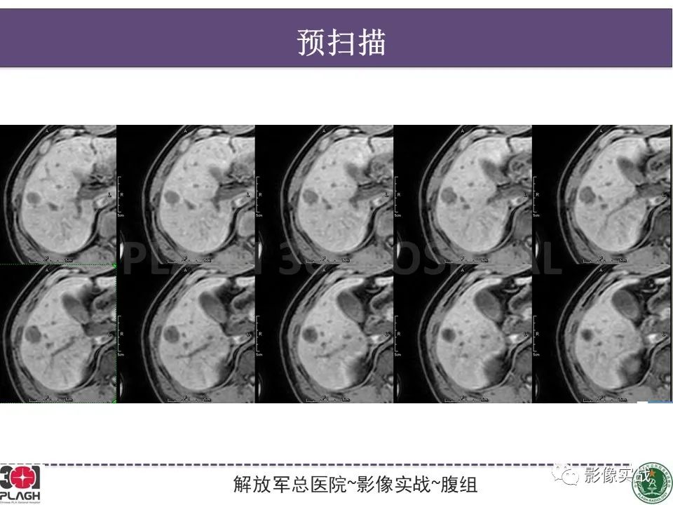 影像PPT - 【病例】肝脏神经内分泌肿瘤-8