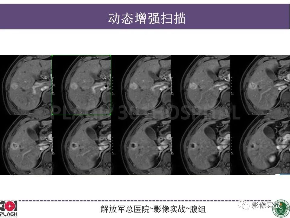 影像PPT - 【病例】肝脏神经内分泌肿瘤-9