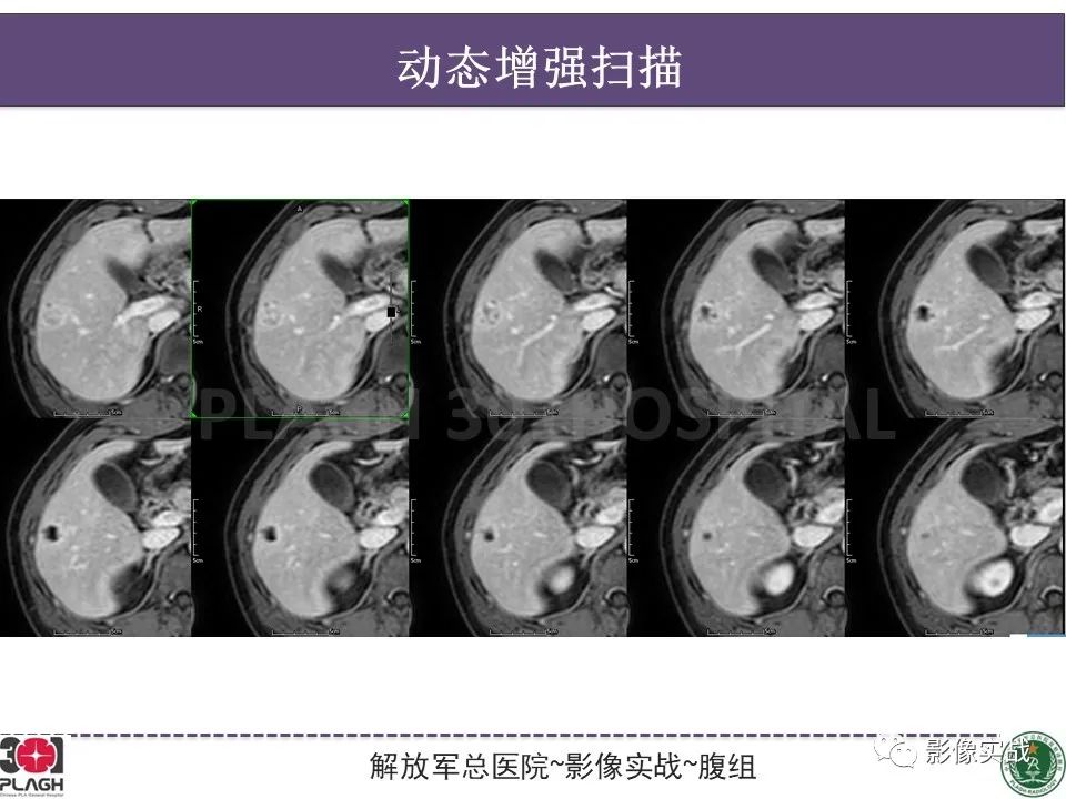 影像PPT - 【病例】肝脏神经内分泌肿瘤-10
