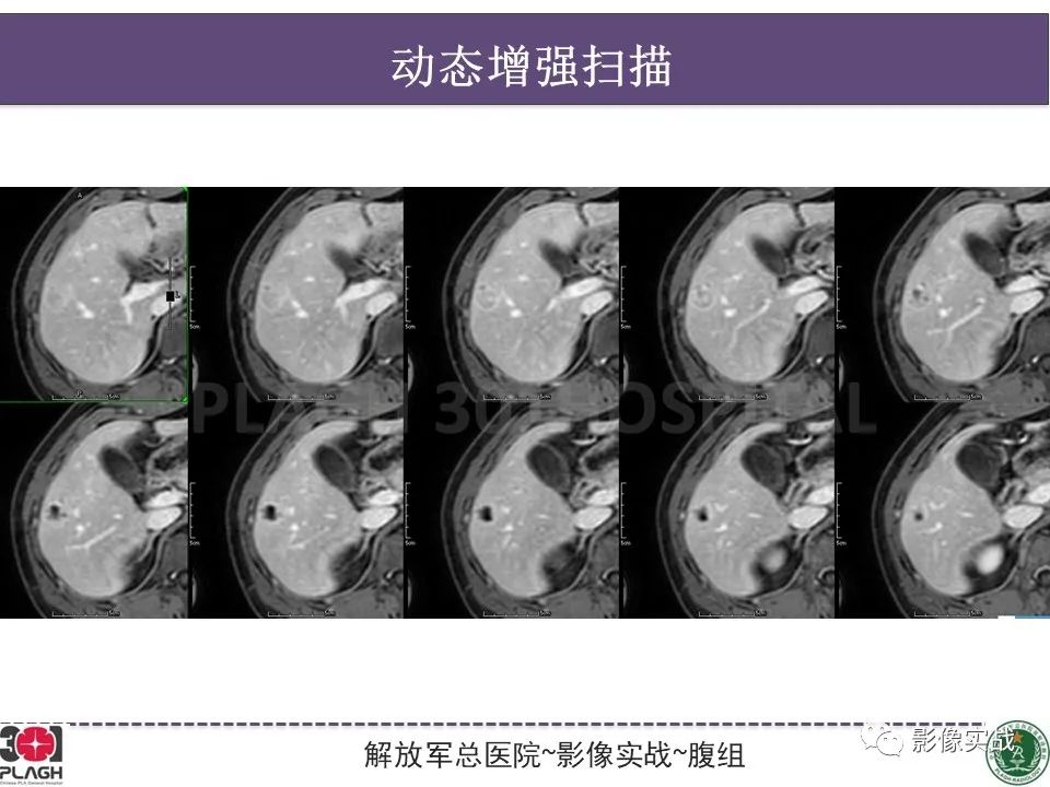 影像PPT - 【病例】肝脏神经内分泌肿瘤-11
