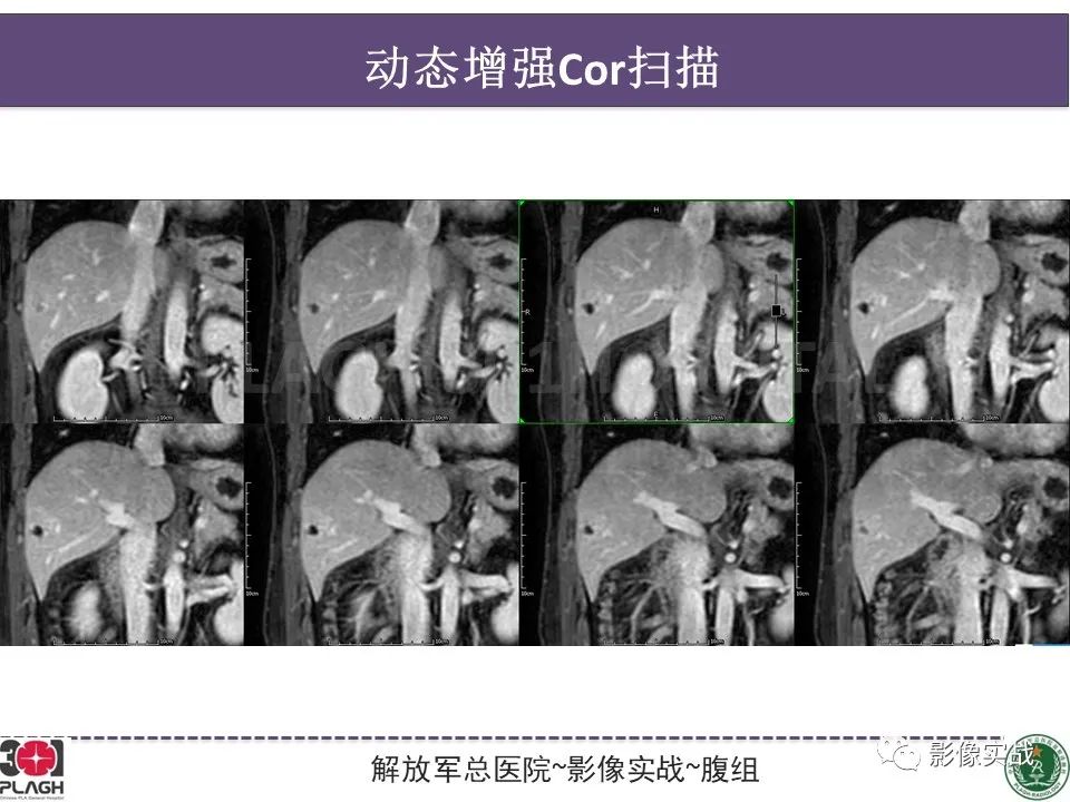 影像PPT - 【病例】肝脏神经内分泌肿瘤-12