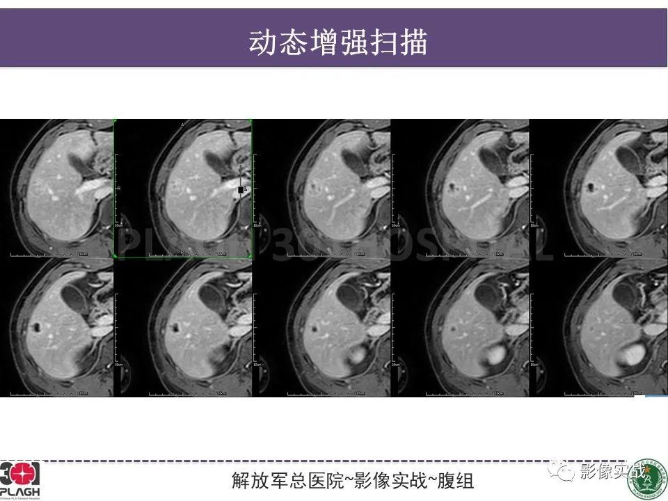影像PPT - 【病例】肝脏神经内分泌肿瘤-13